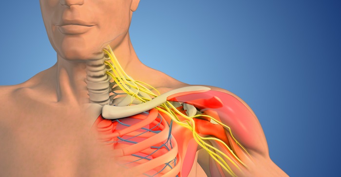 Scalenii syndrom (nerveavklemming i nakkegropen)